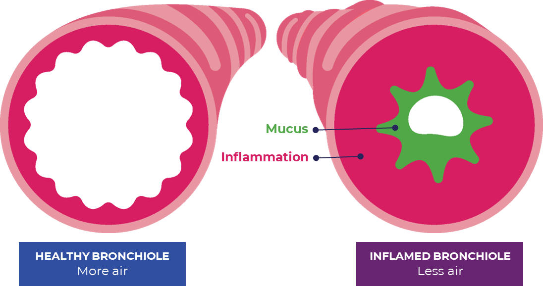 Brionchiole graphic